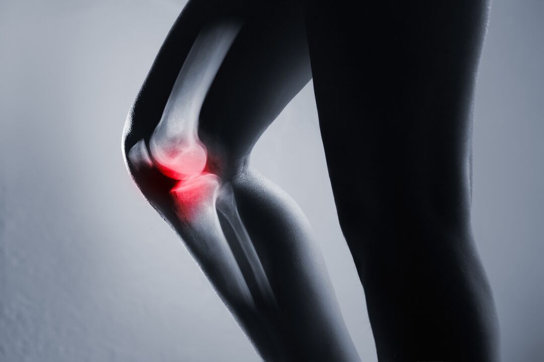 inflamación de la articulación de la rodilla con artrosis