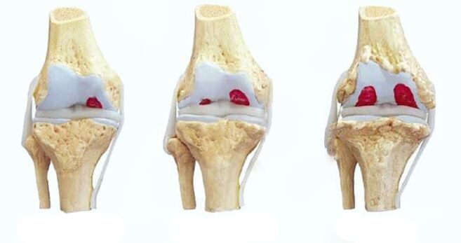 etapas de la artrosis de rodilla