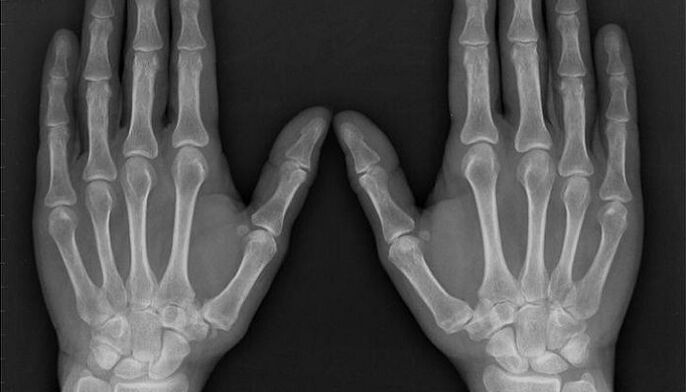 radiografía para el diagnóstico de artritis y artrosis