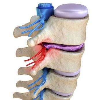 Un nervio pellizcado en la columna vertebral se acompaña de un dolor punzante. 