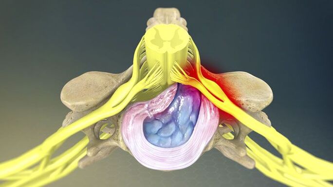 Una de las causas del dolor de espalda es una hernia de disco. 