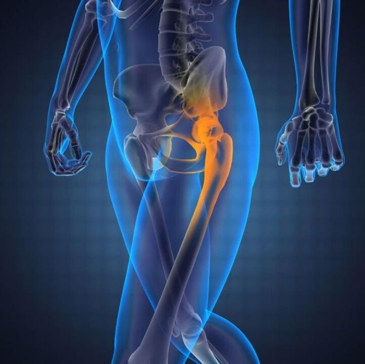 artrosis de la articulación de la cadera