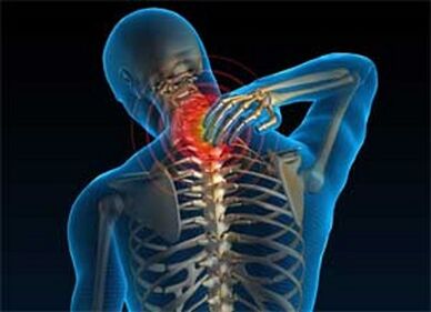 El dolor en el cuello es un síntoma común de osteocondrosis
