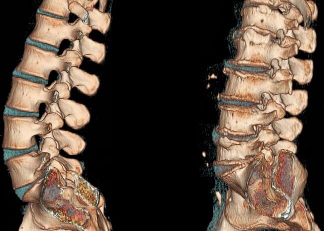 Osteocondrosis de la región lumbar