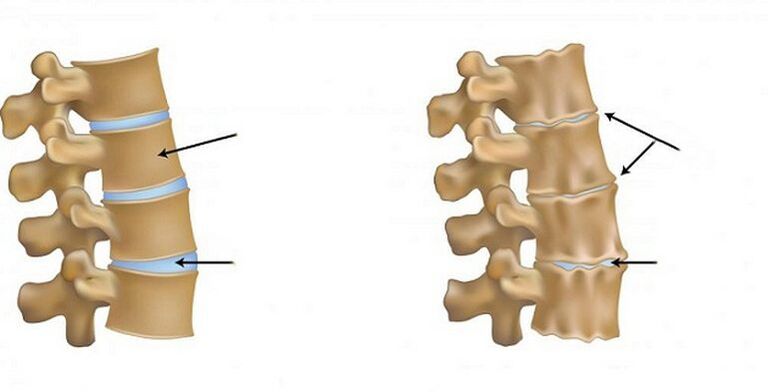 Síndrome isquémico para la osteocondrosis