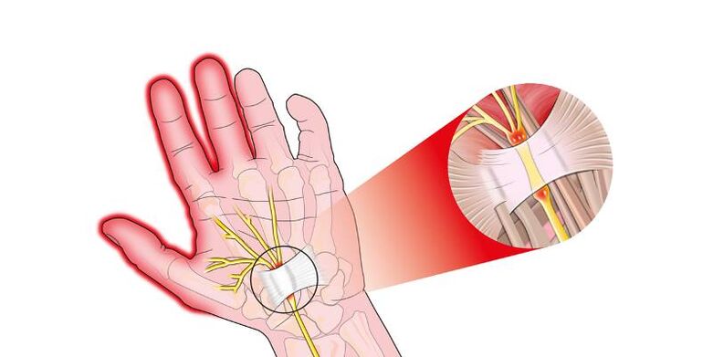 Dolor en las articulaciones de los dedos con risartrosis