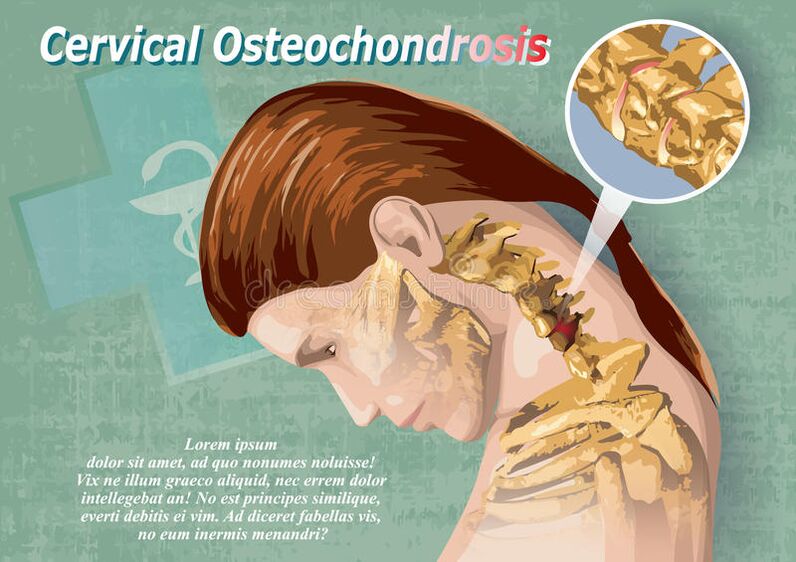 La osteocondrosis cervical es una enfermedad del tejido cartilaginoso.