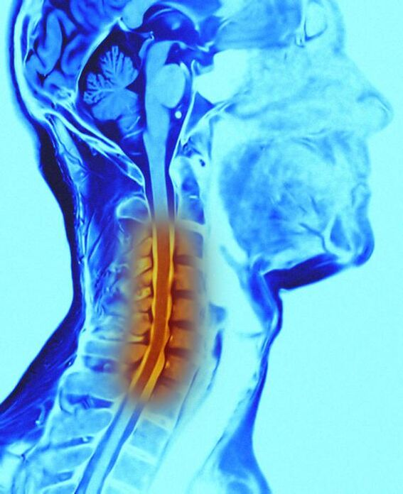 columna cervical y osteocondrosis