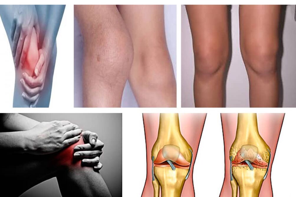 síntomas de artrosis de rodilla